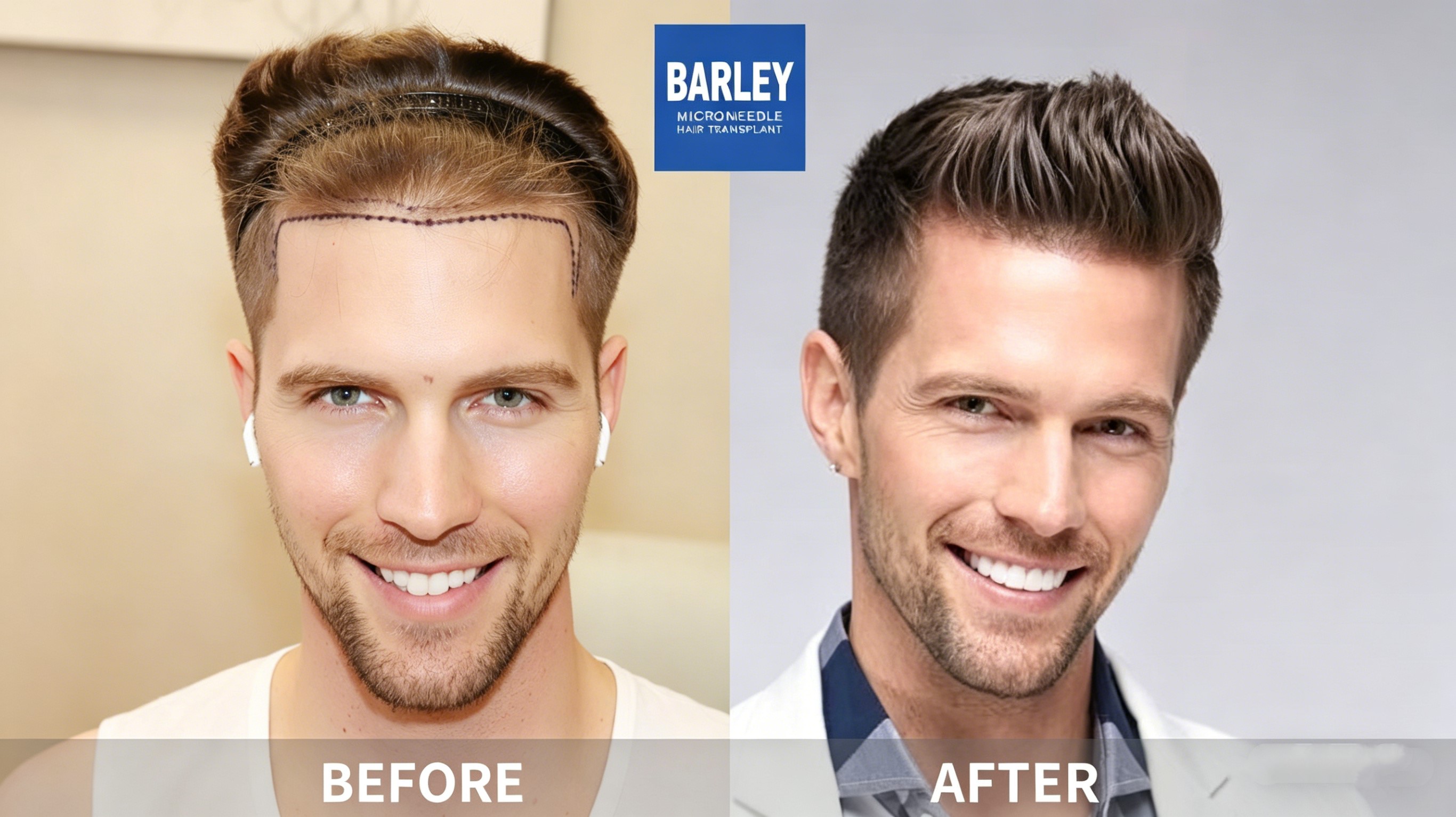 Expert Hair Transplant Doctors at Barley Hospital