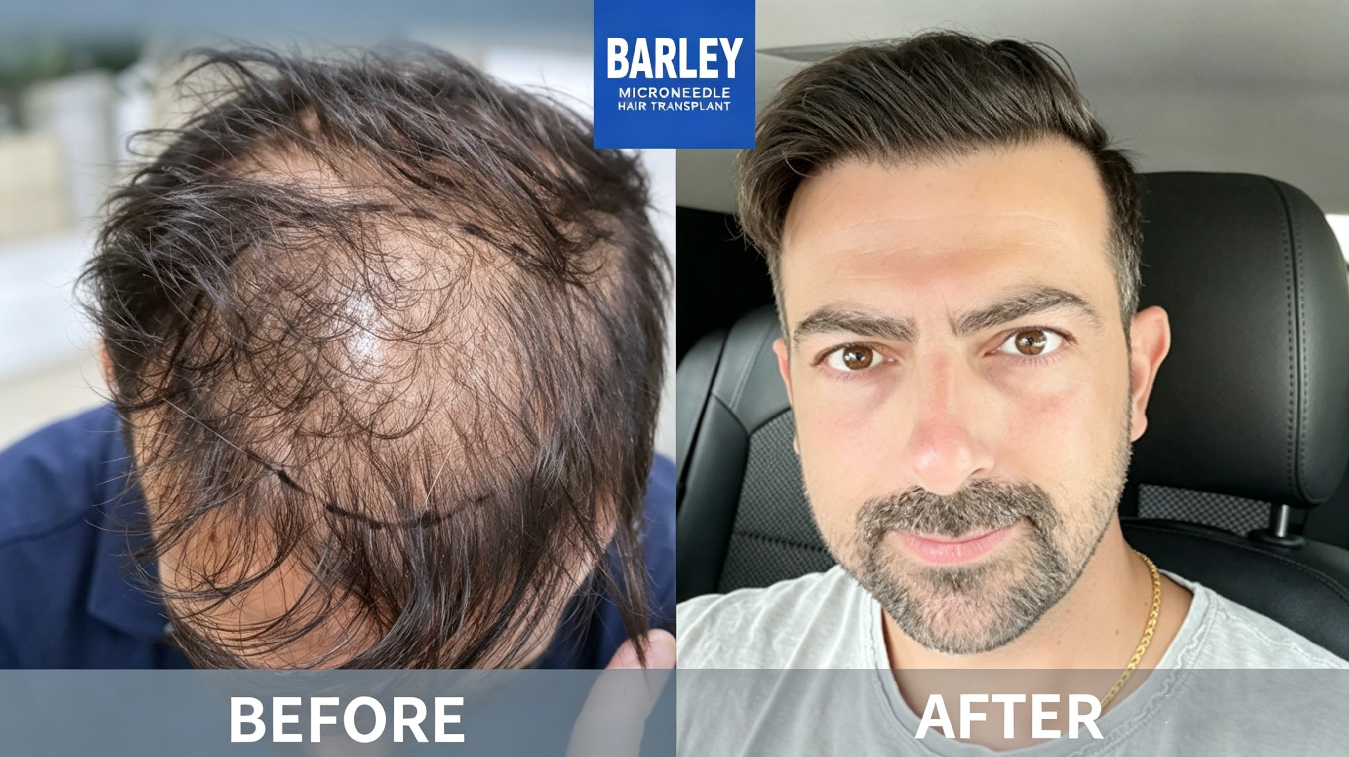 Frequently Asked Questions About Hair Transplant