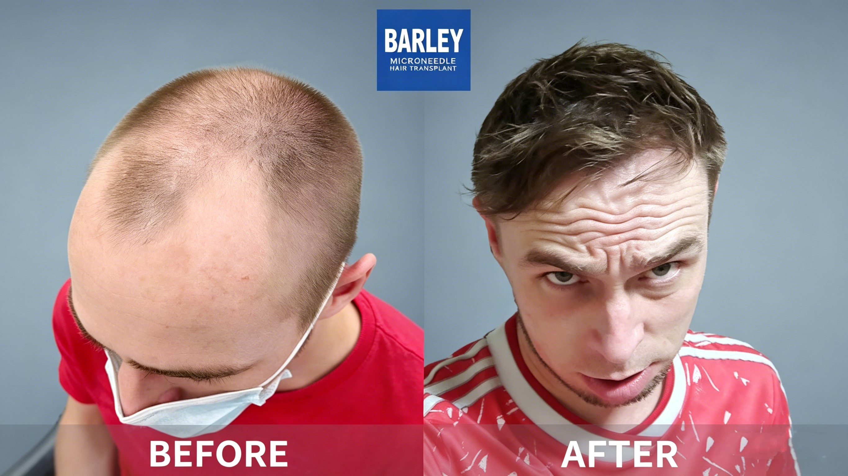 Hair Transplant Services in China - Barley Hospital