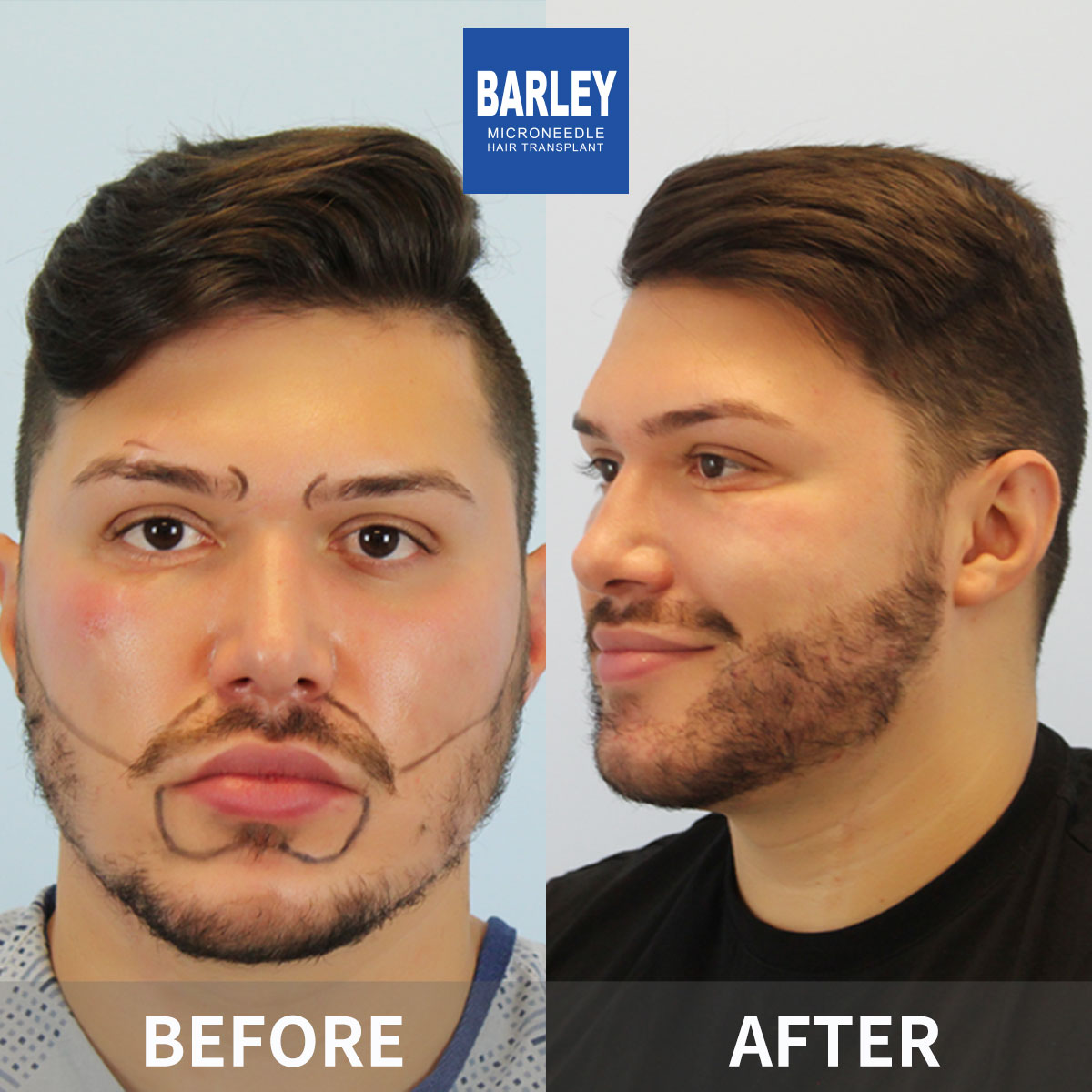 Sideburn transplant results