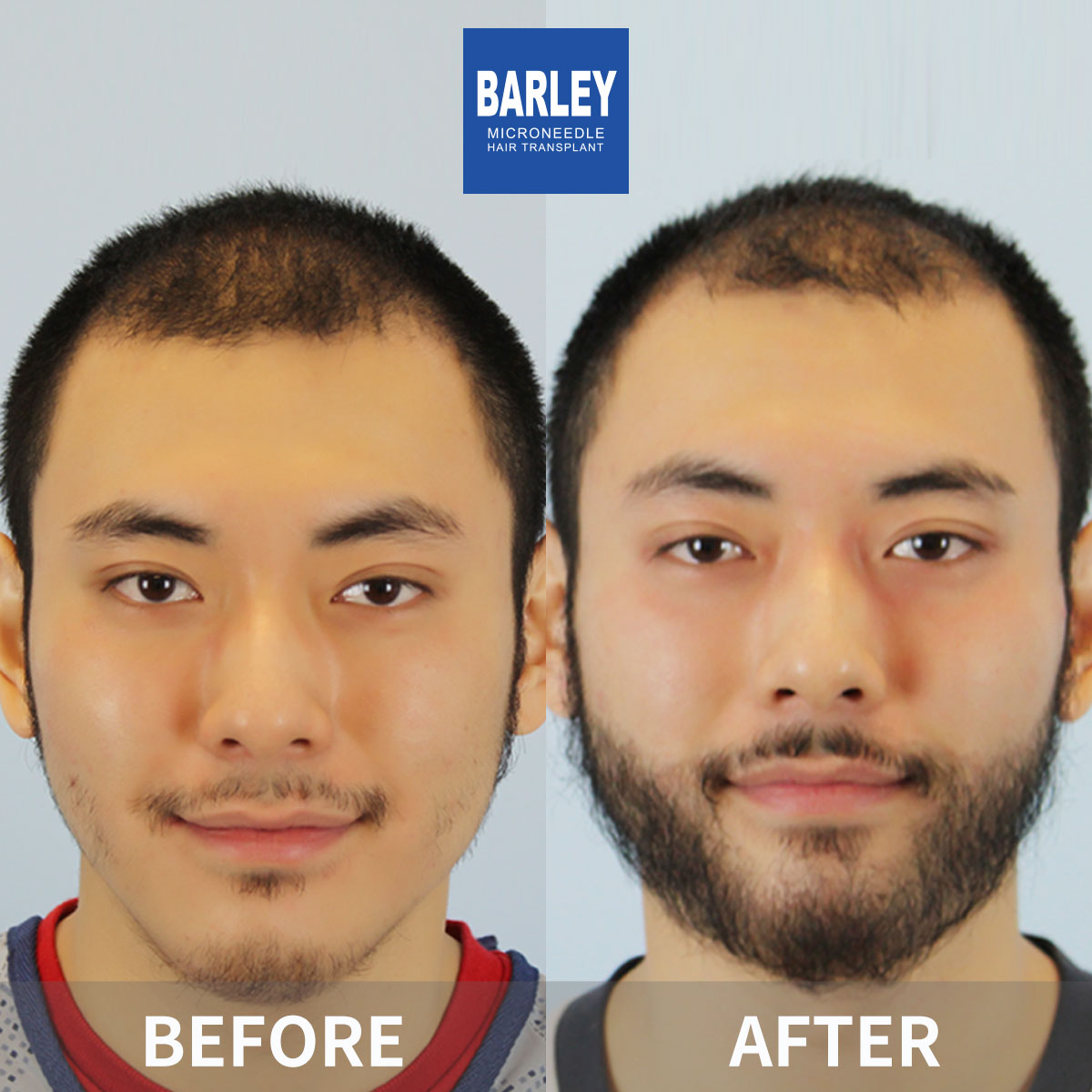 Beard transplant before and after