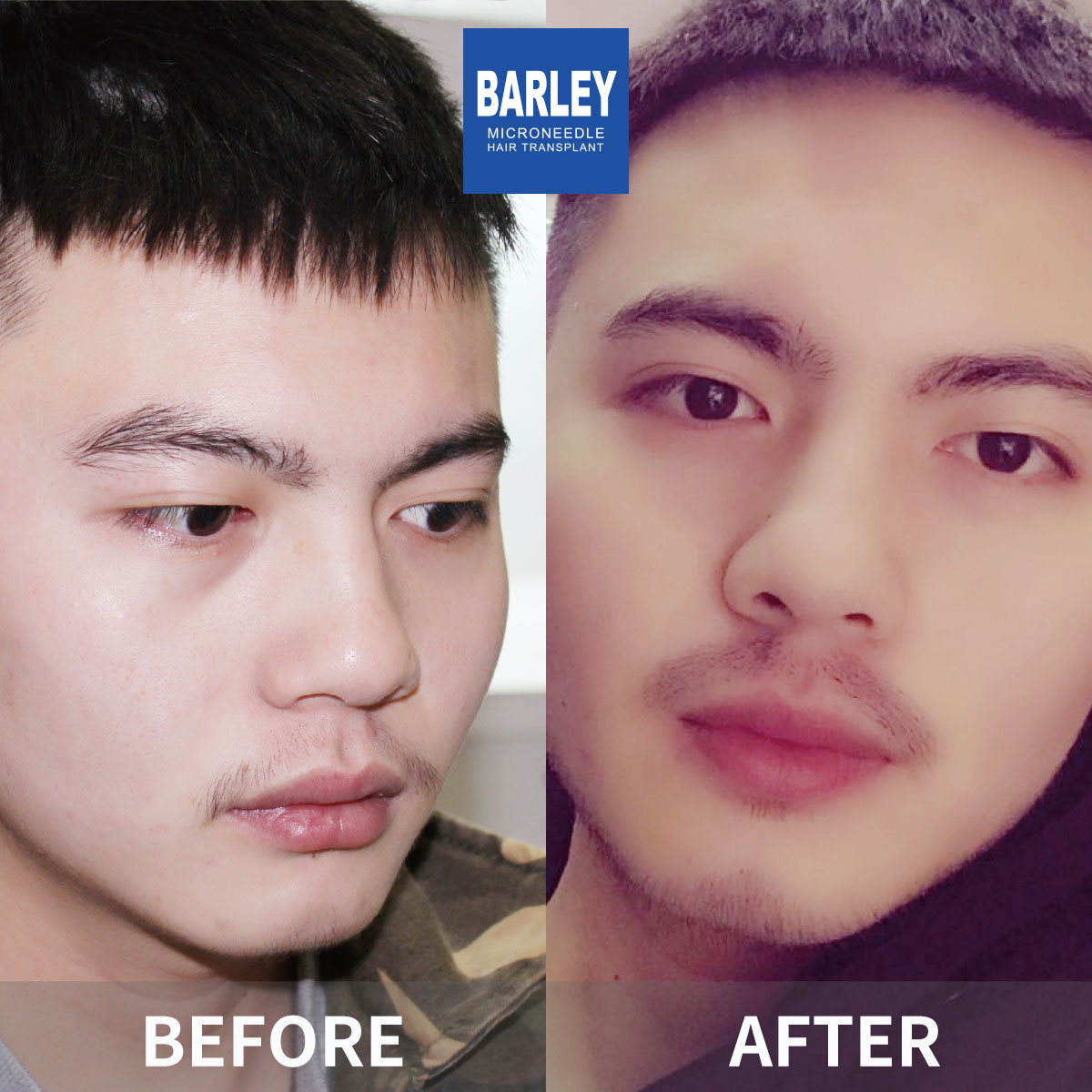 Beard transplant before and after