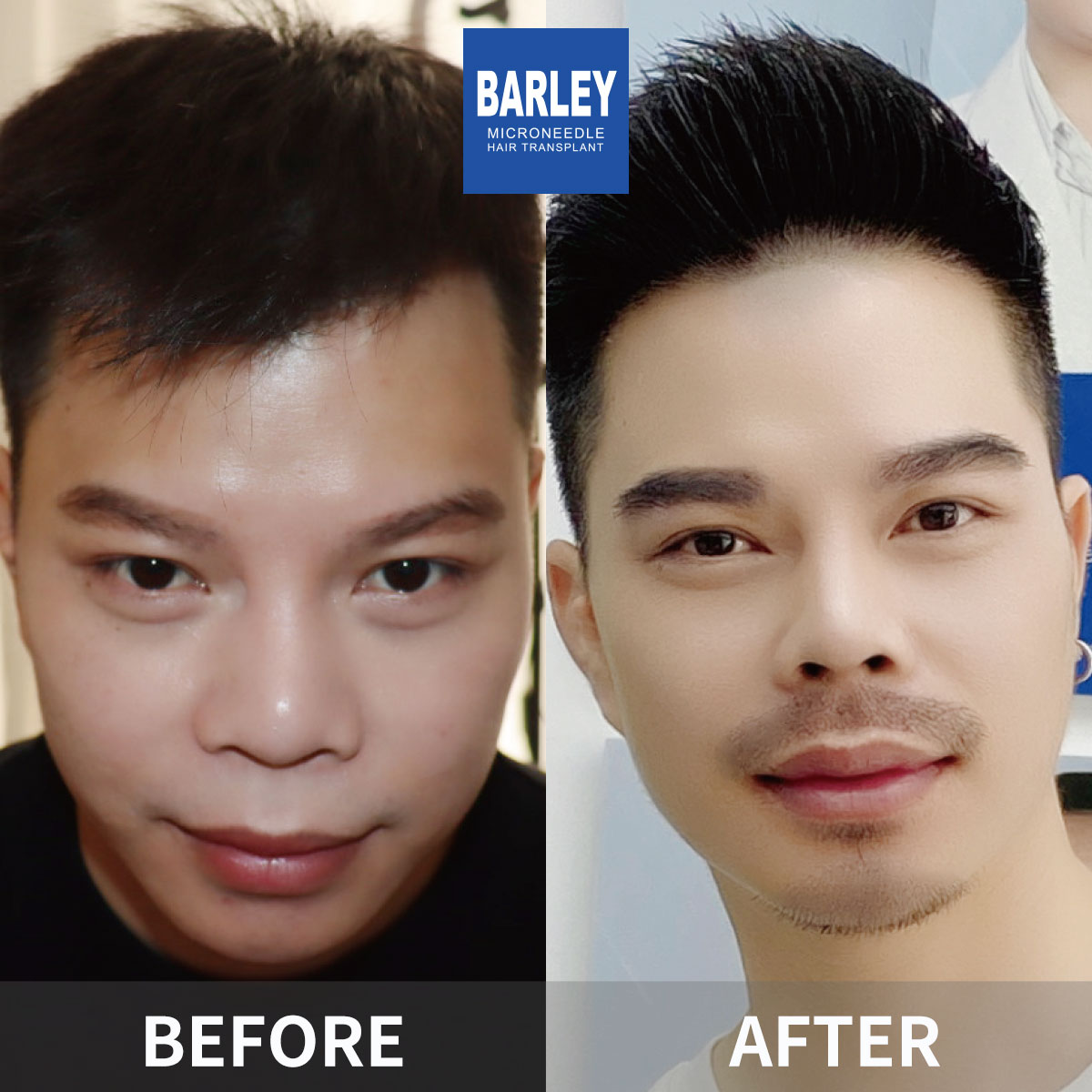 Beard transplant before and after