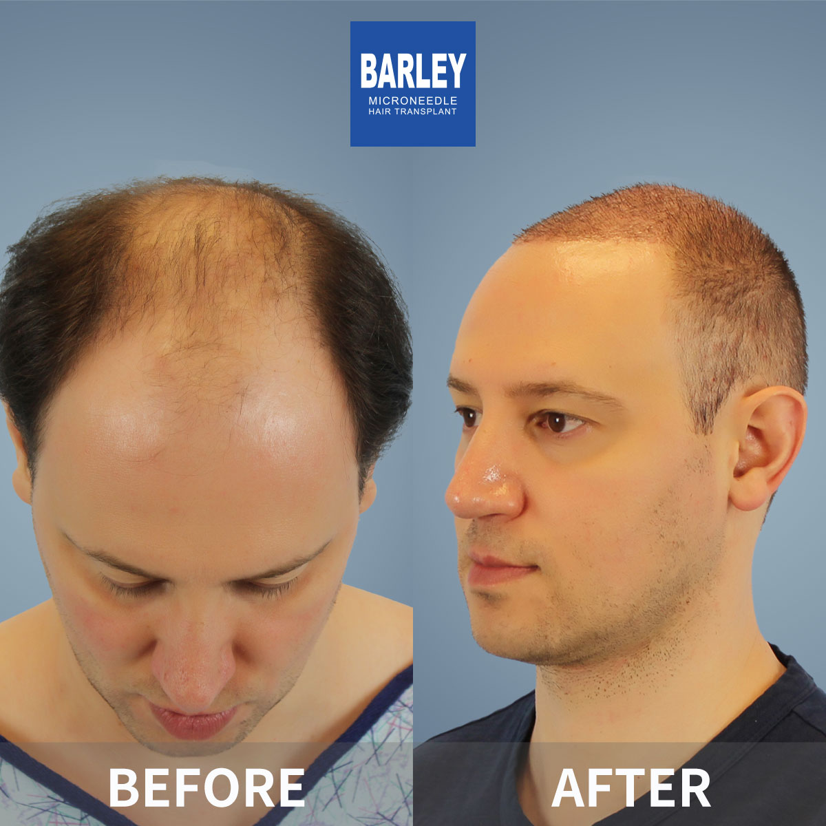 Hair density enhancement results