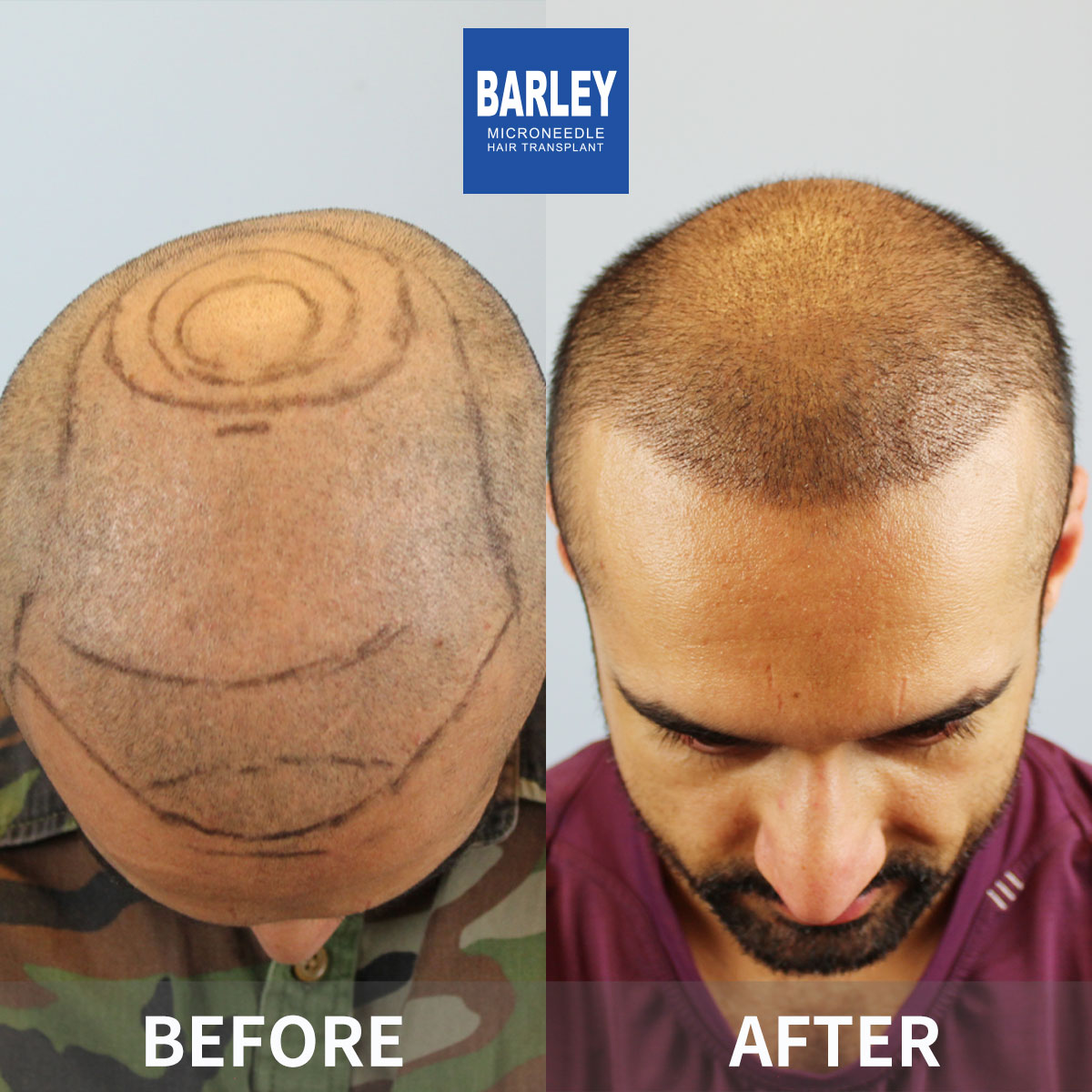 Baldness treatment before and after