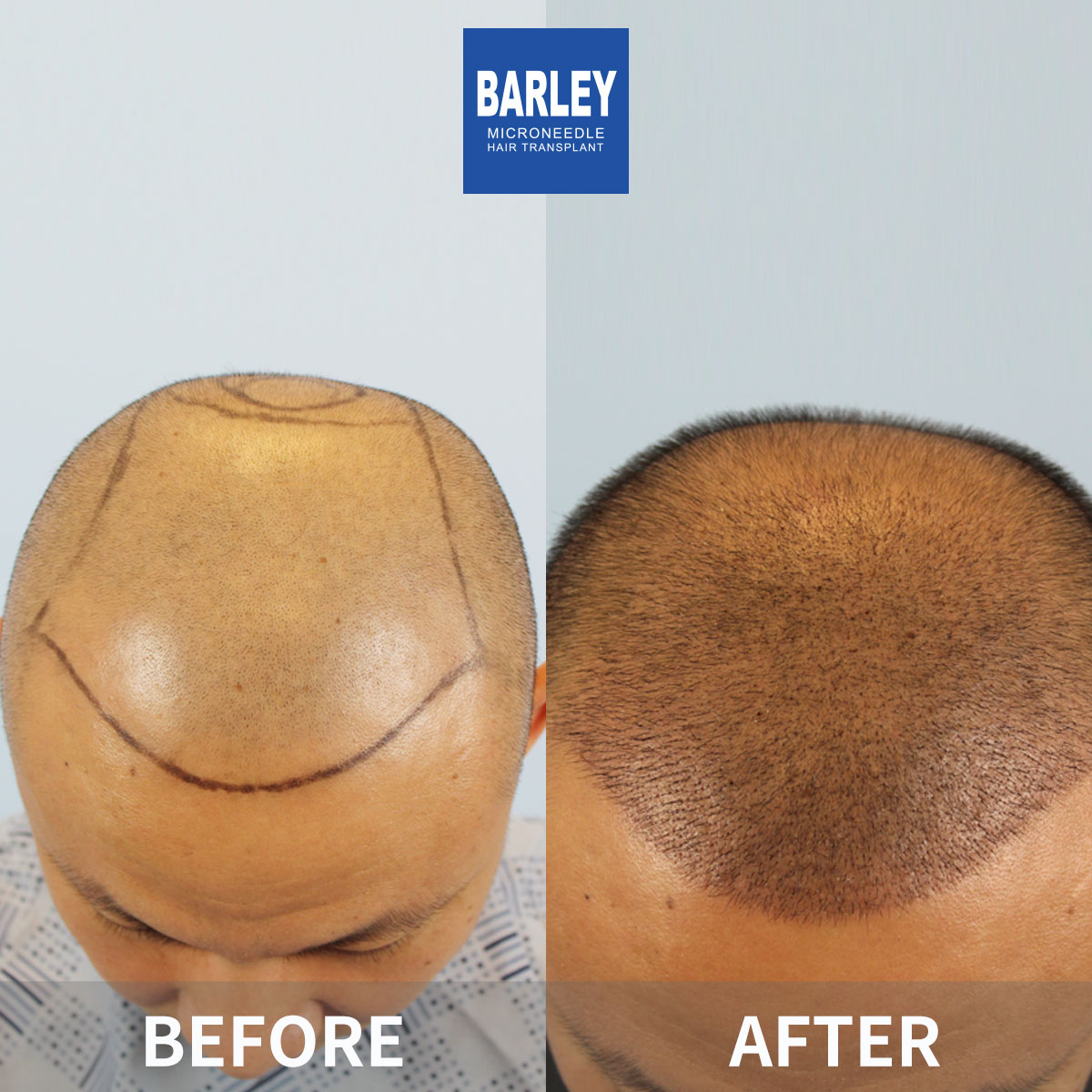 Baldness treatment before and after