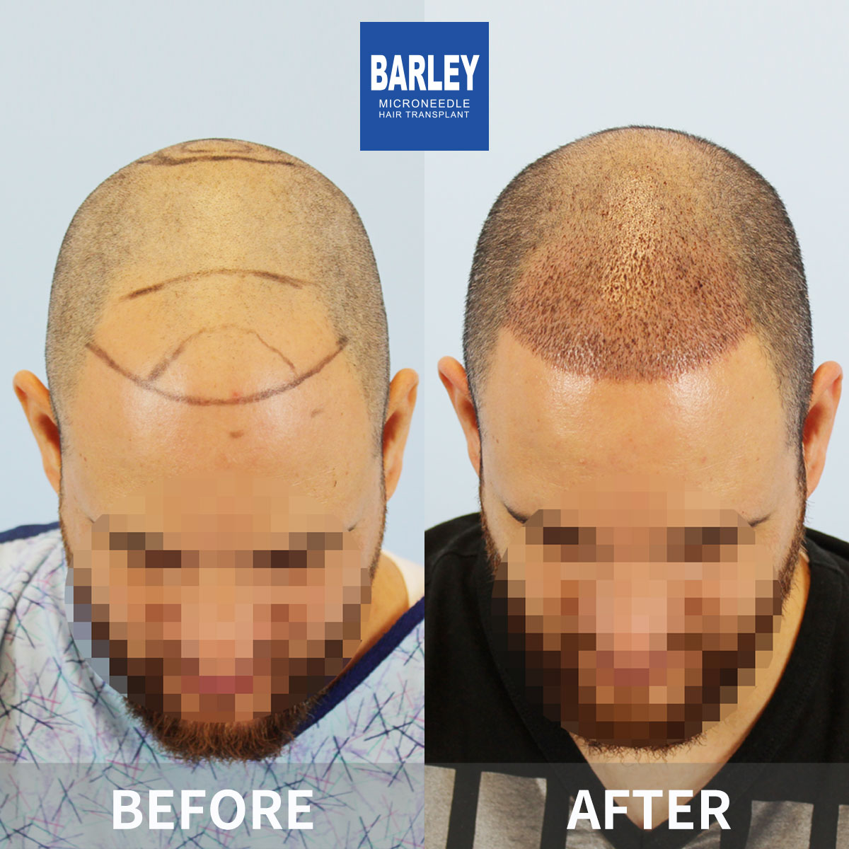 Baldness treatment before and after