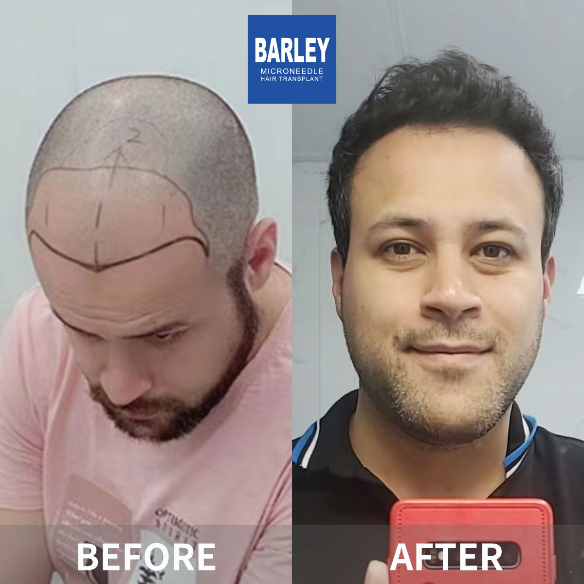 Baldness treatment before and after