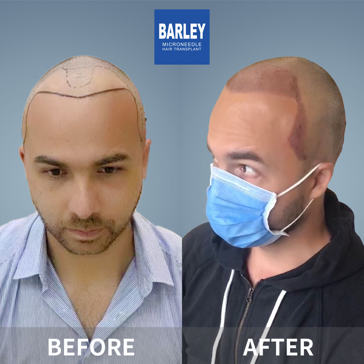 Baldness treatment before and after