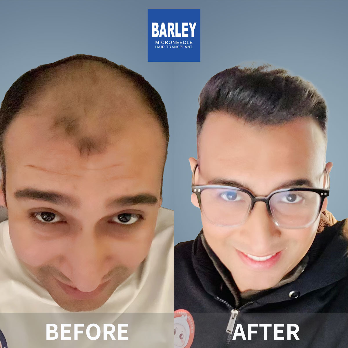 Baldness treatment before and after