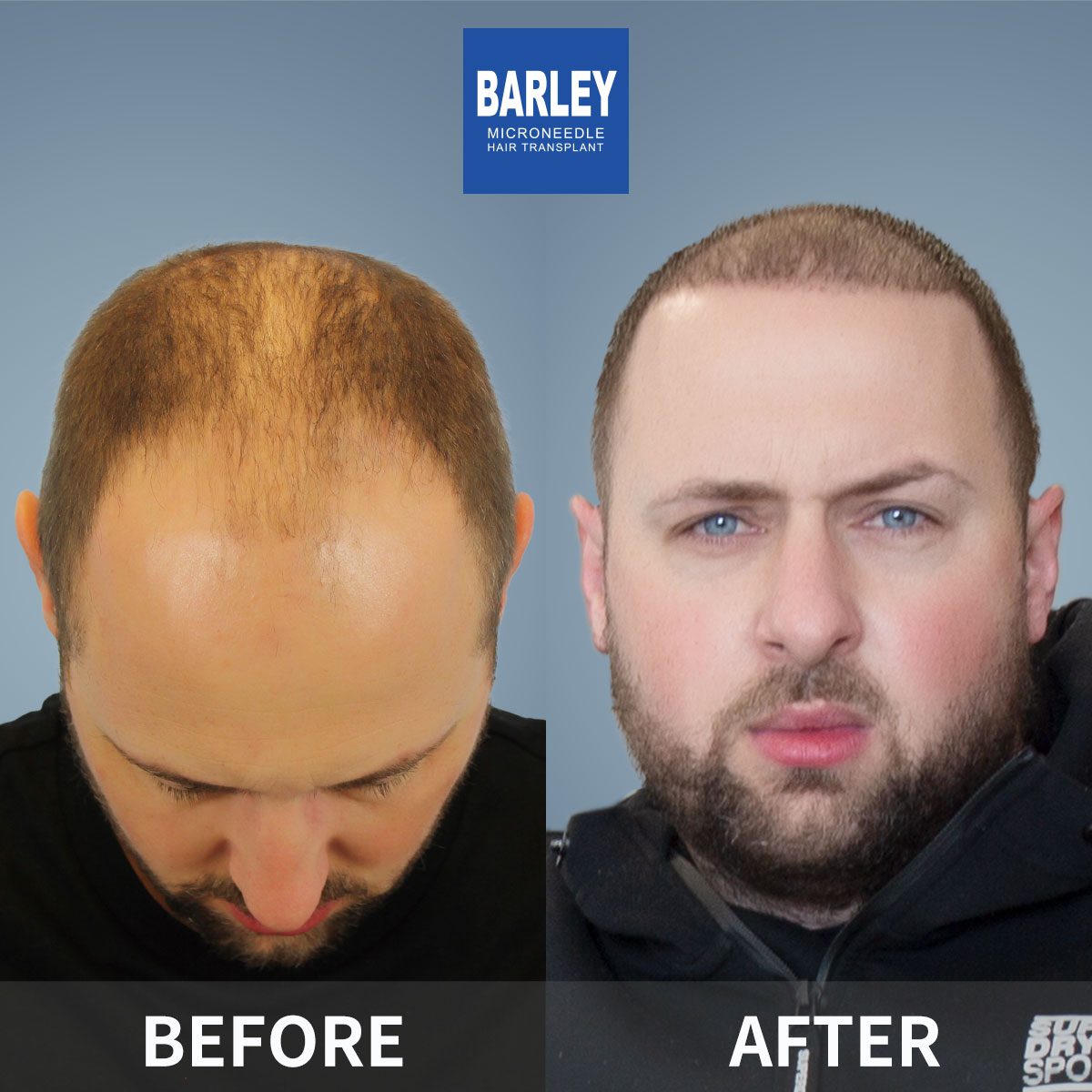 Scar treatment results