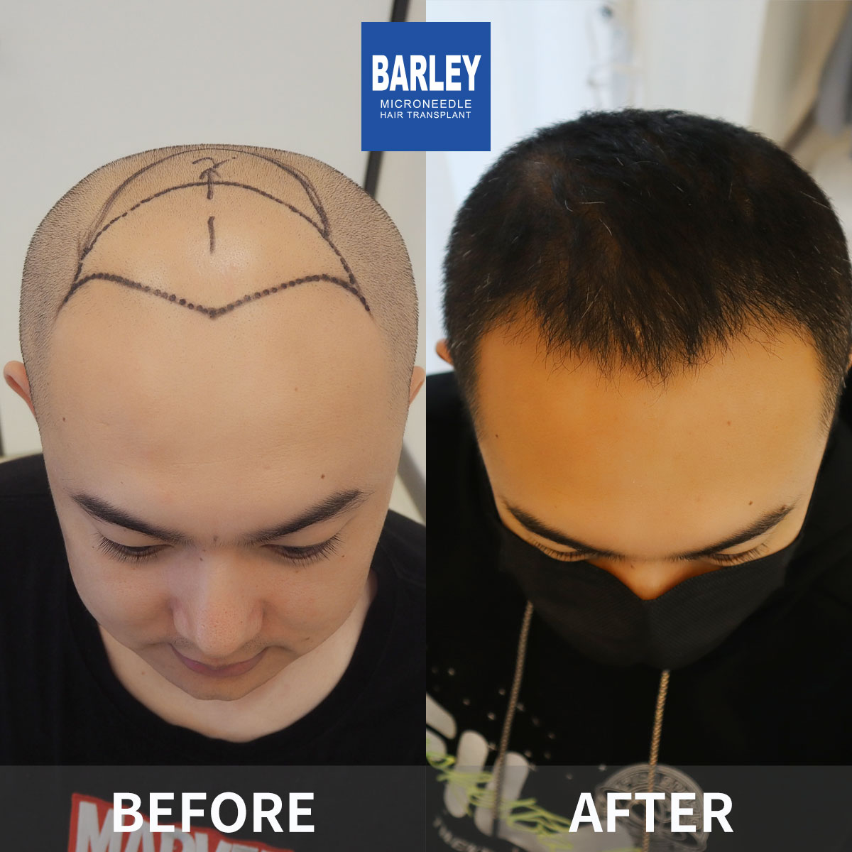 Baldness treatment before and after