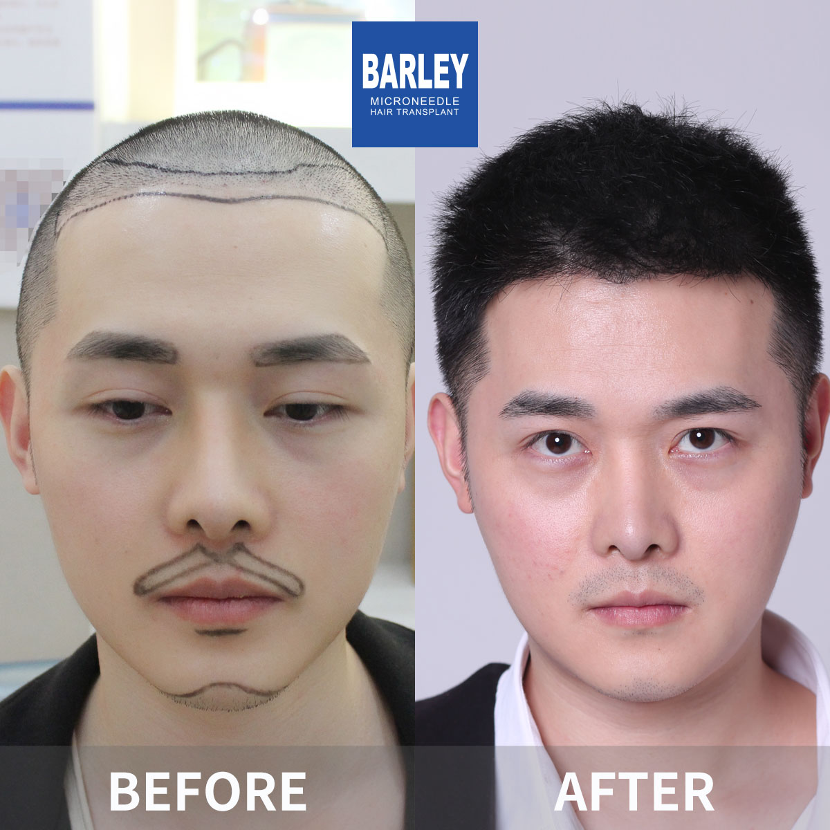 Baldness treatment before and after