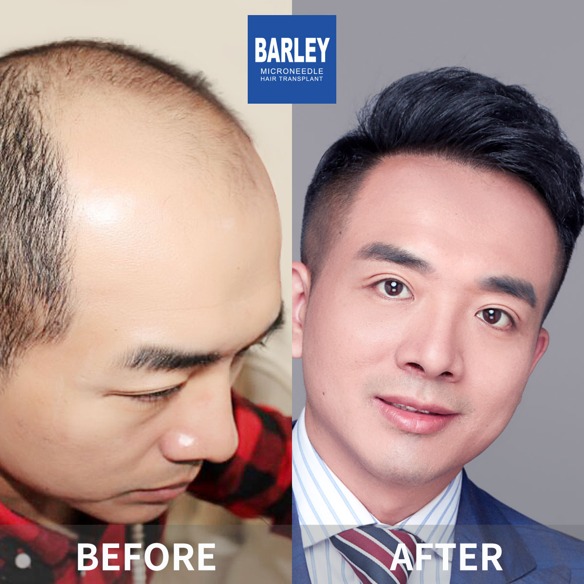 Baldness treatment before and after