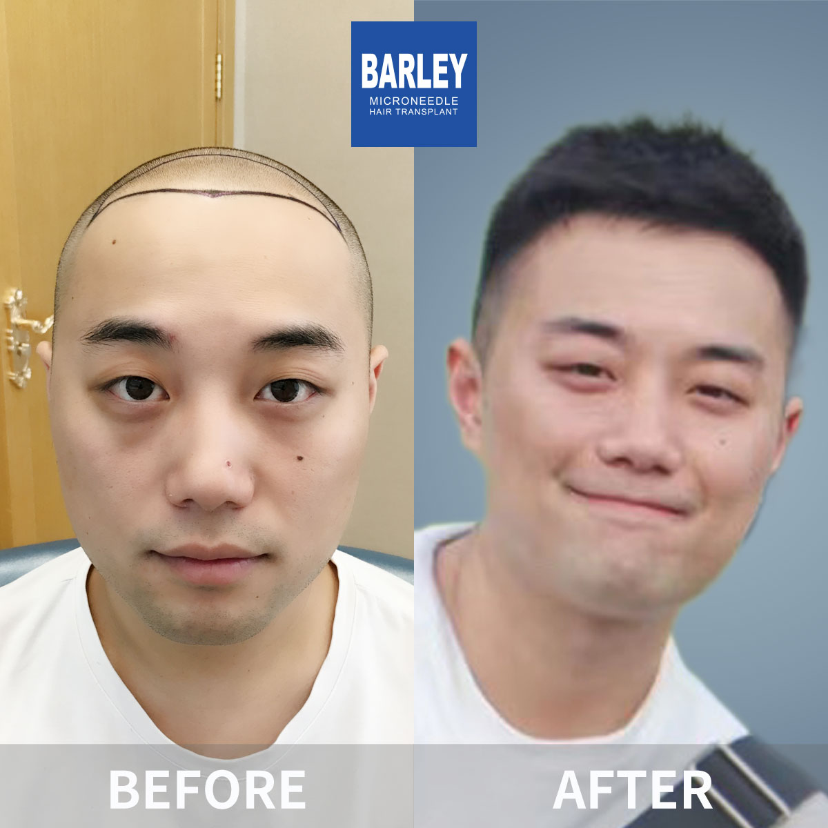 Baldness treatment before and after
