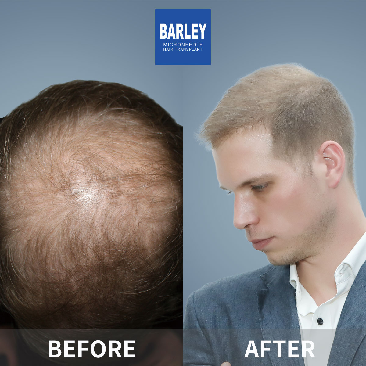 Baldness restoration results