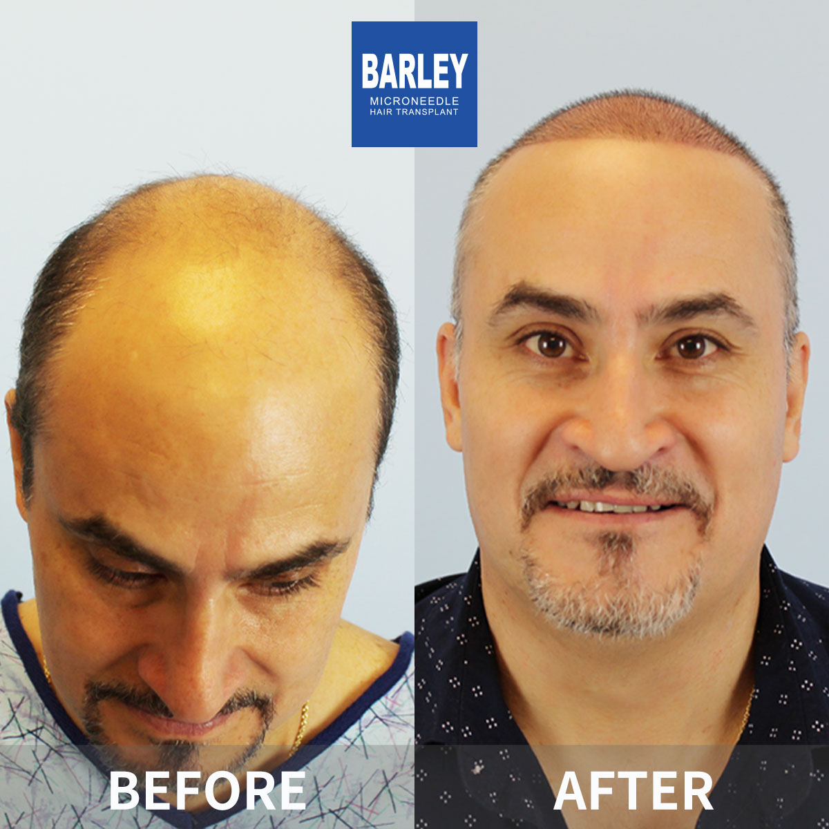 Baldness treatment before and after