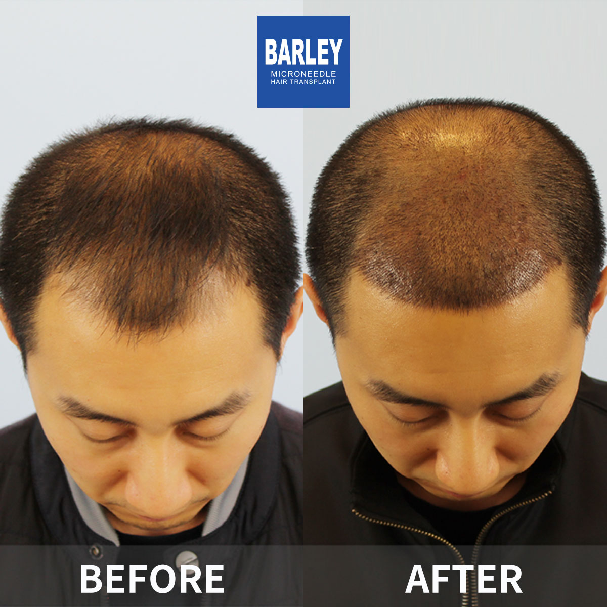 Baldness treatment before and after