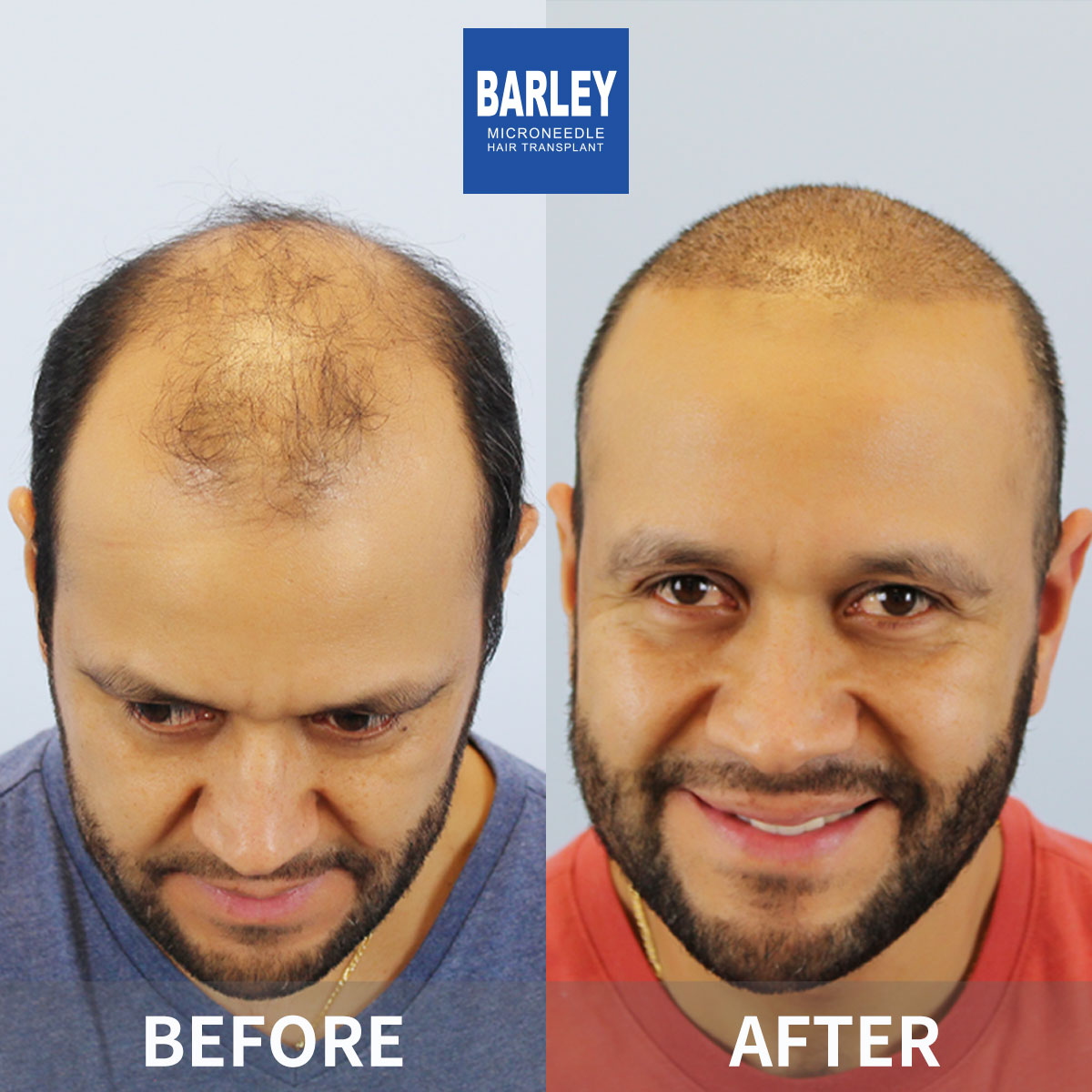 Baldness treatment before and after