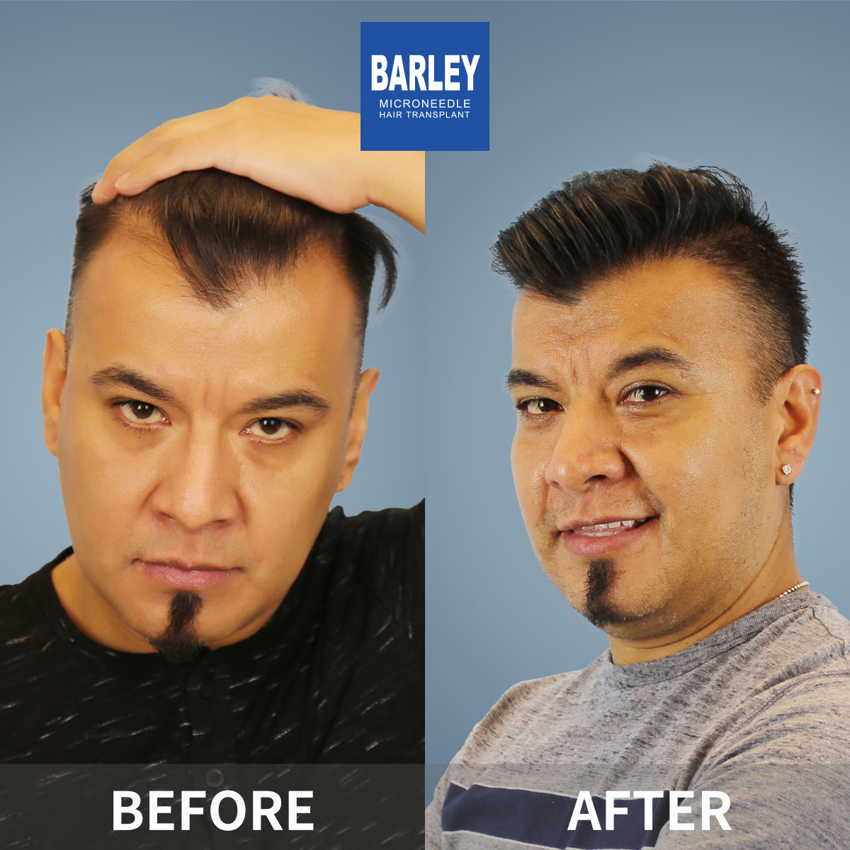 Hairline transplant results