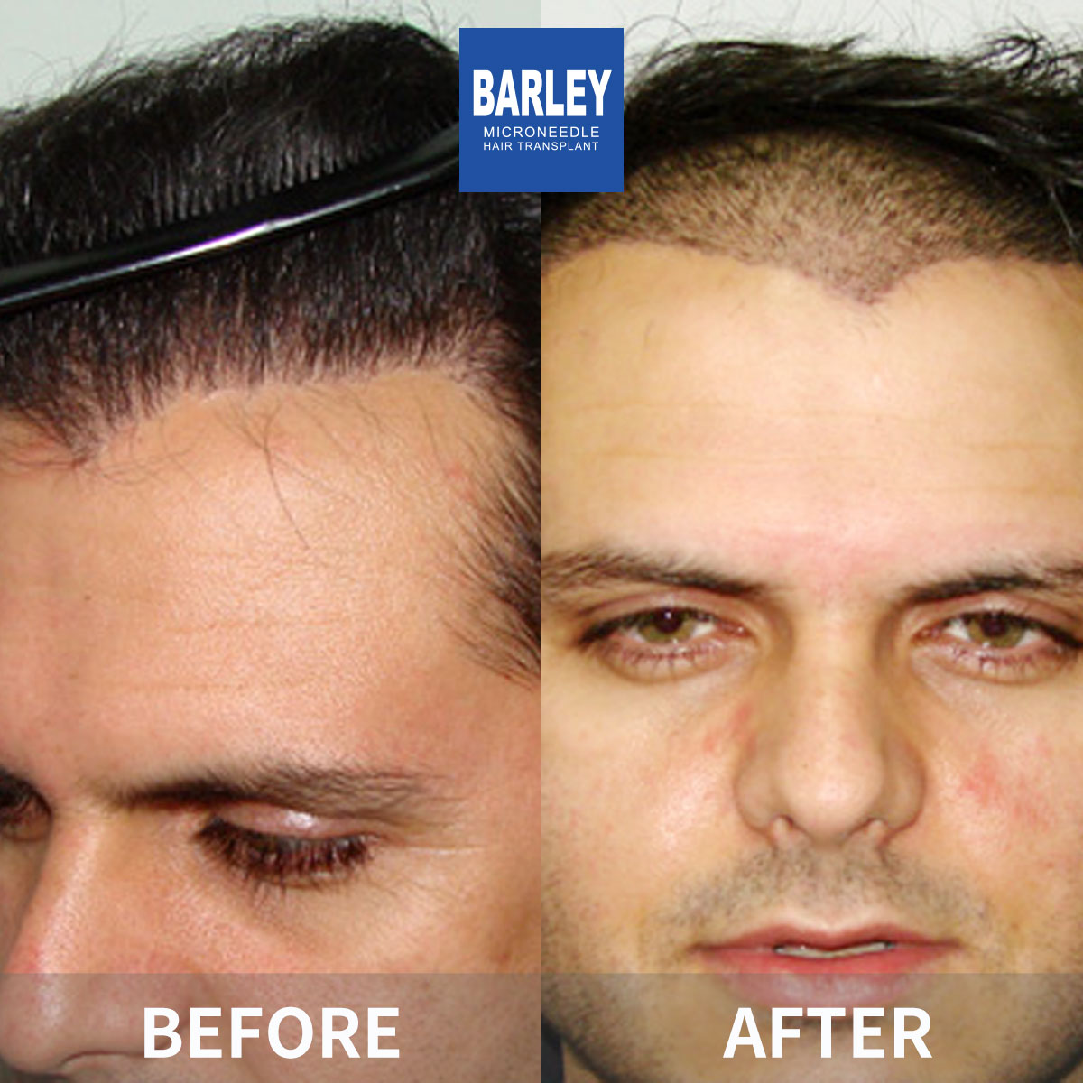 Hairline transplant before and after