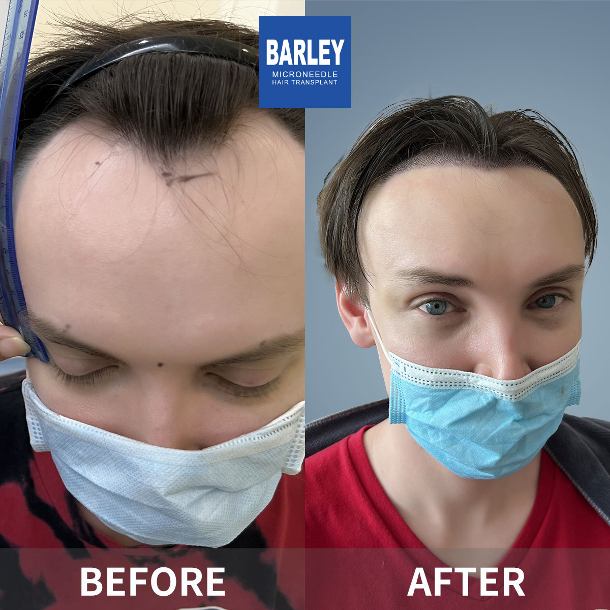 Hairline transplant before and after