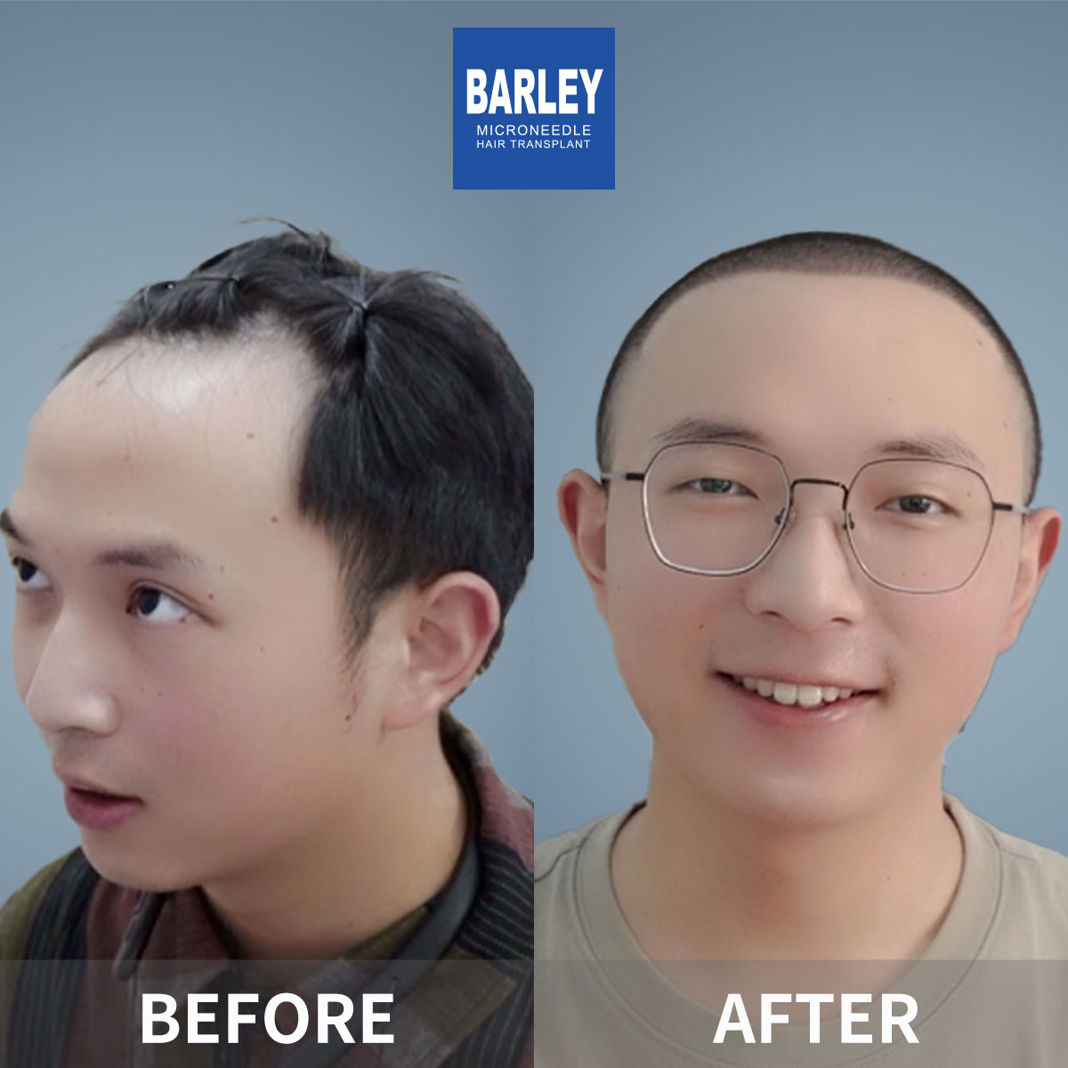Hairline transplant before and after