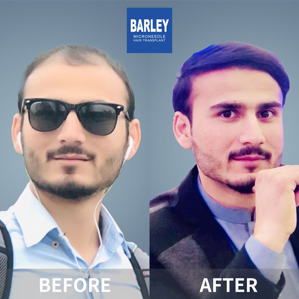 Hairline transplant before and after