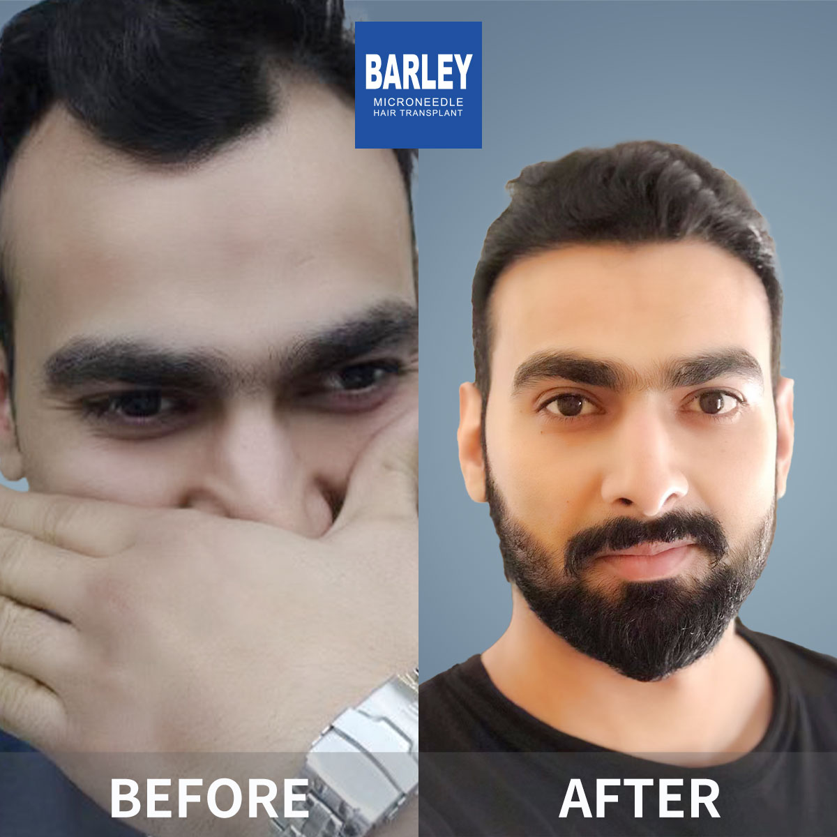 Hairline transplant before and after