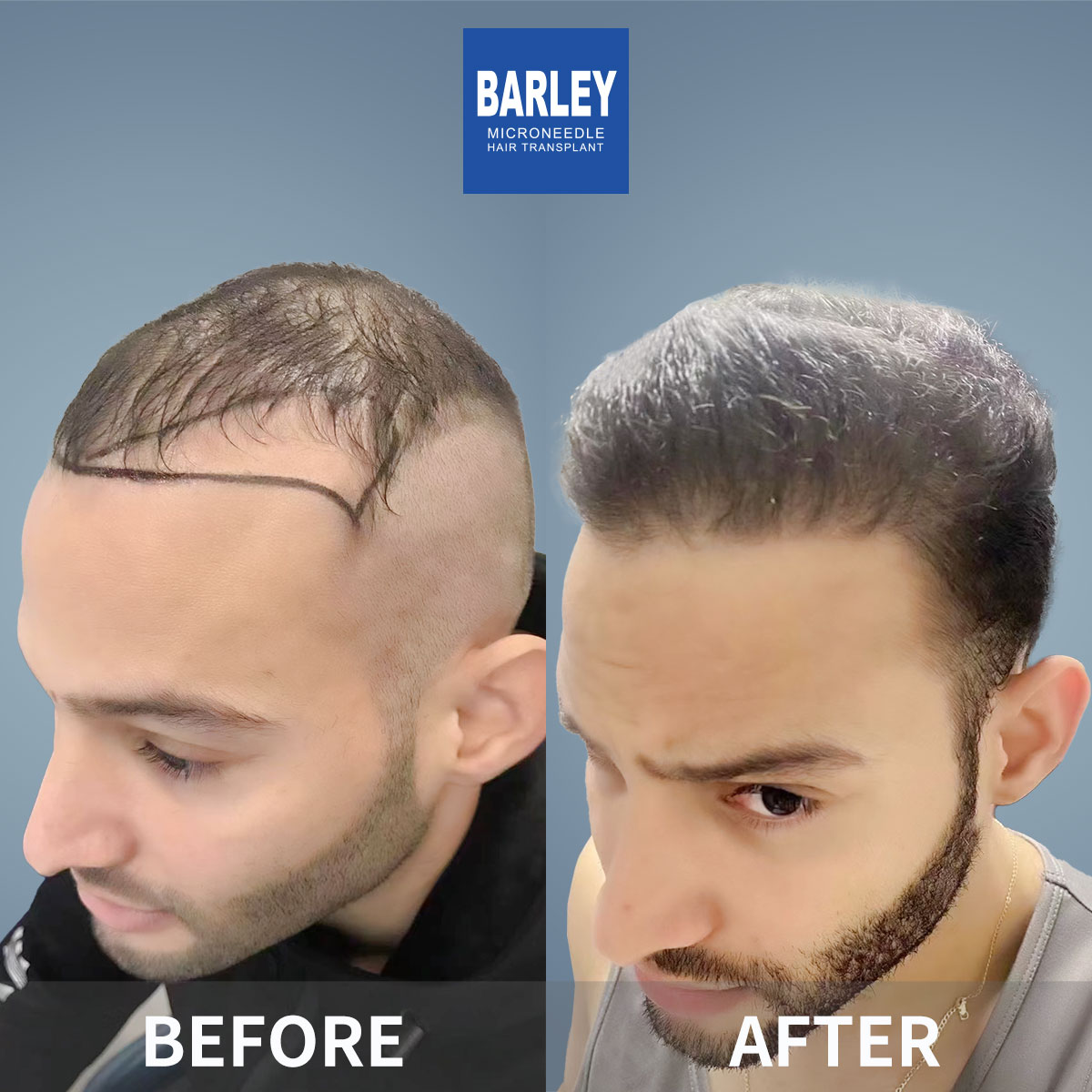 Hairline transplant before and after