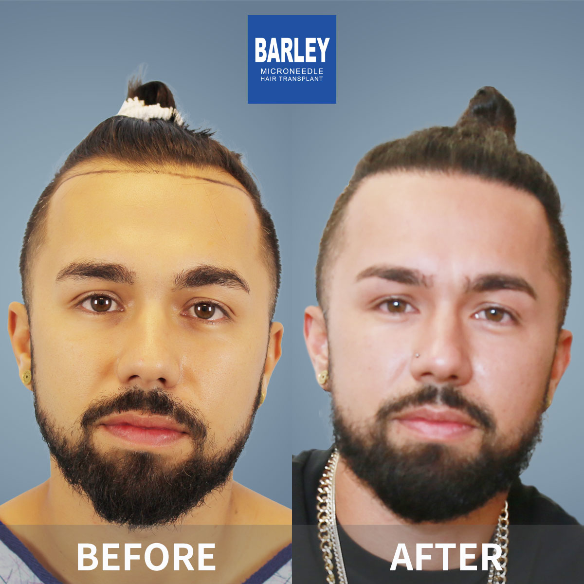 Hair transplant before and after