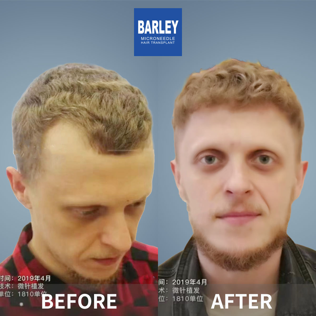 Hairline transplant before and after