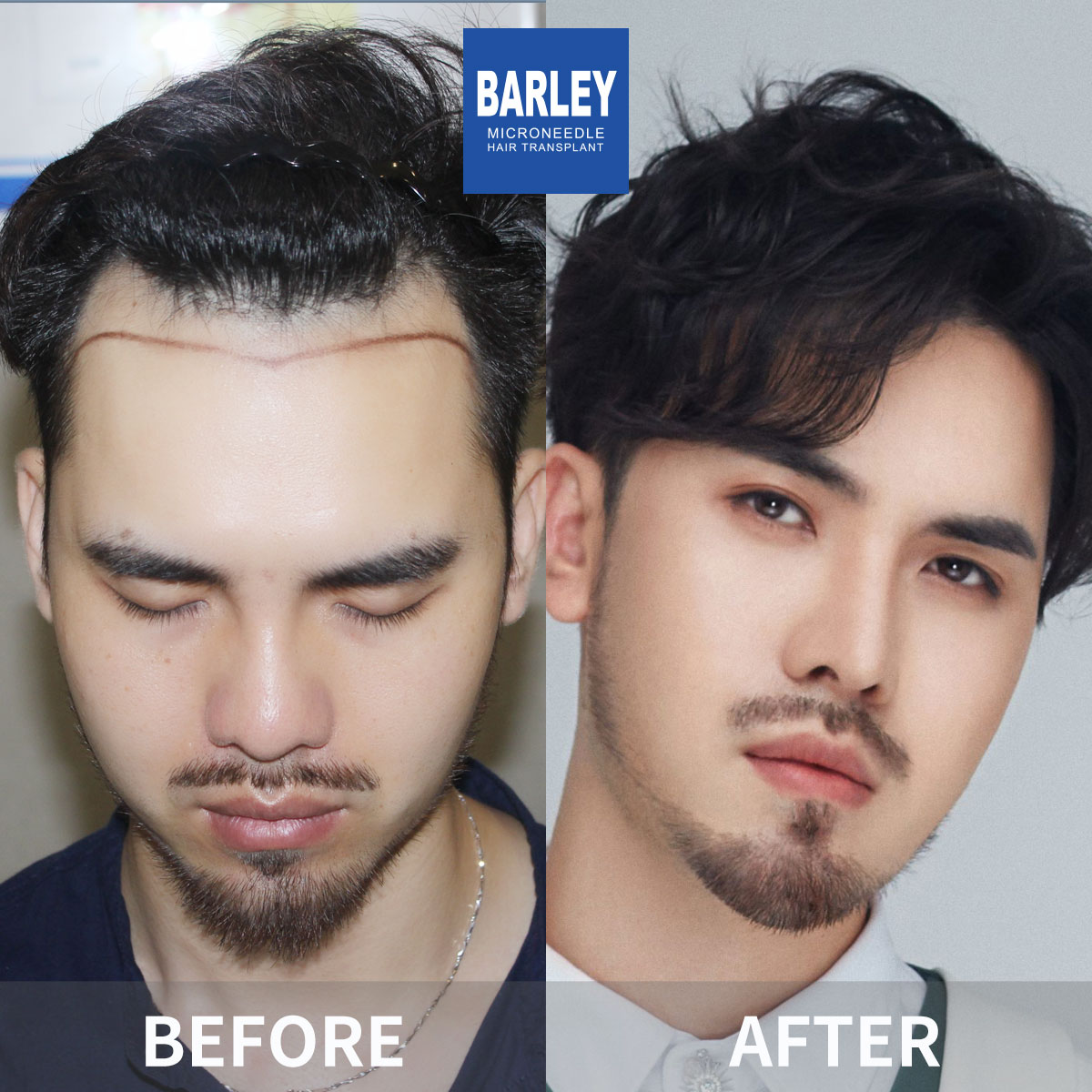 Hairline transplant before and after