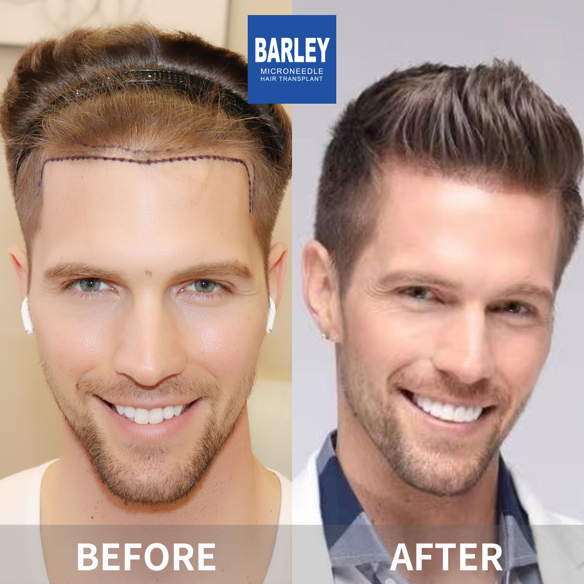 Hairline transplant before and after