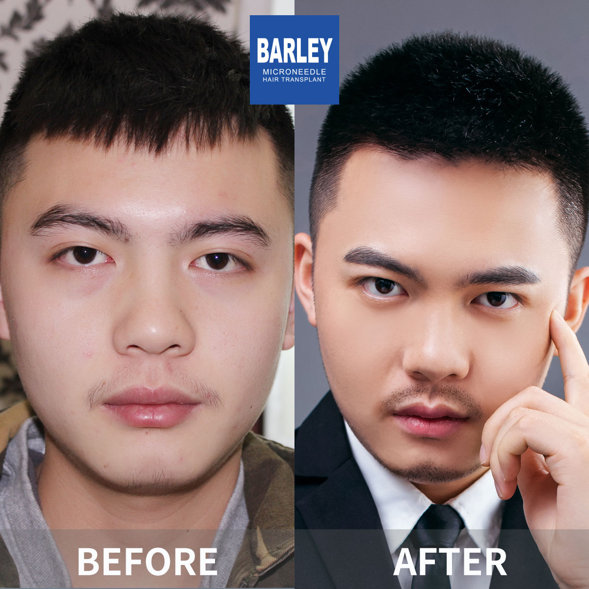 Hairline transplant before and after