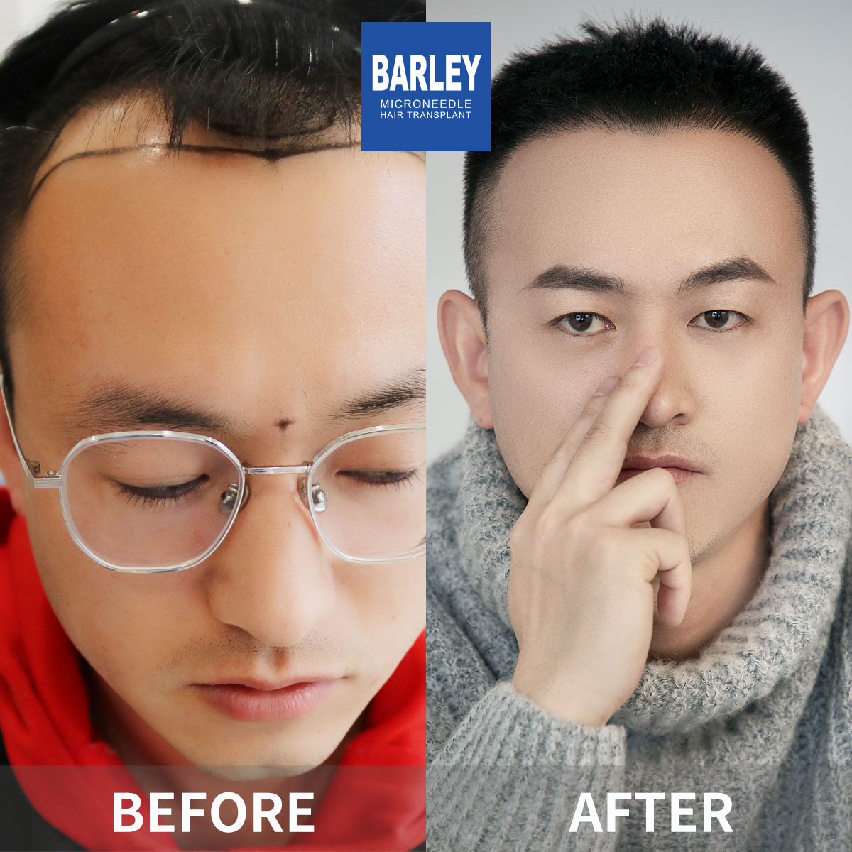 Hairline transplant before and after