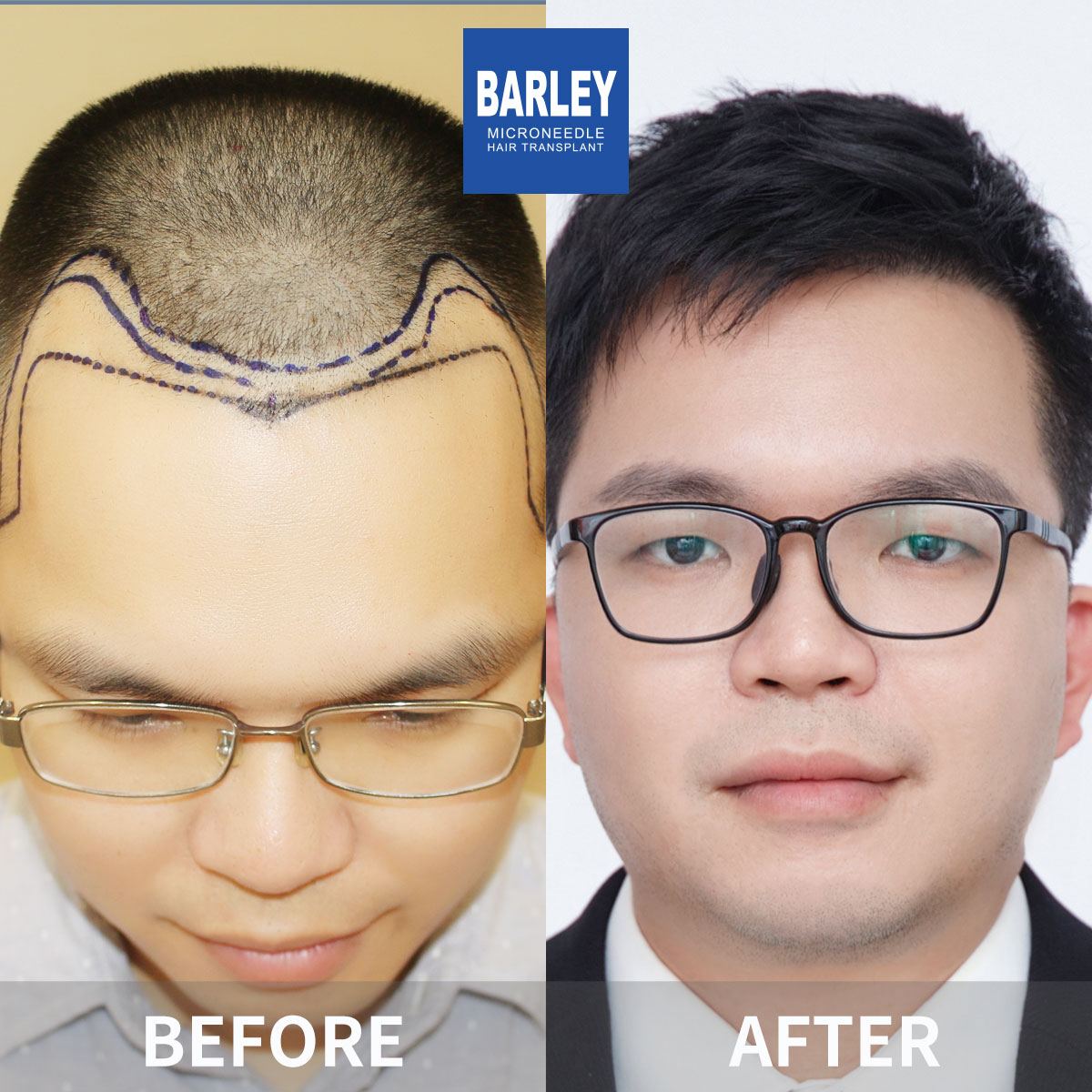Hairline transplant before and after