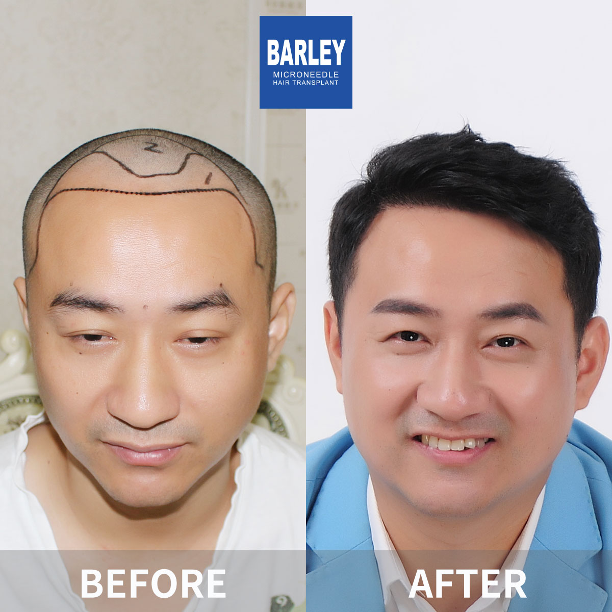 Hairline transplant before and after