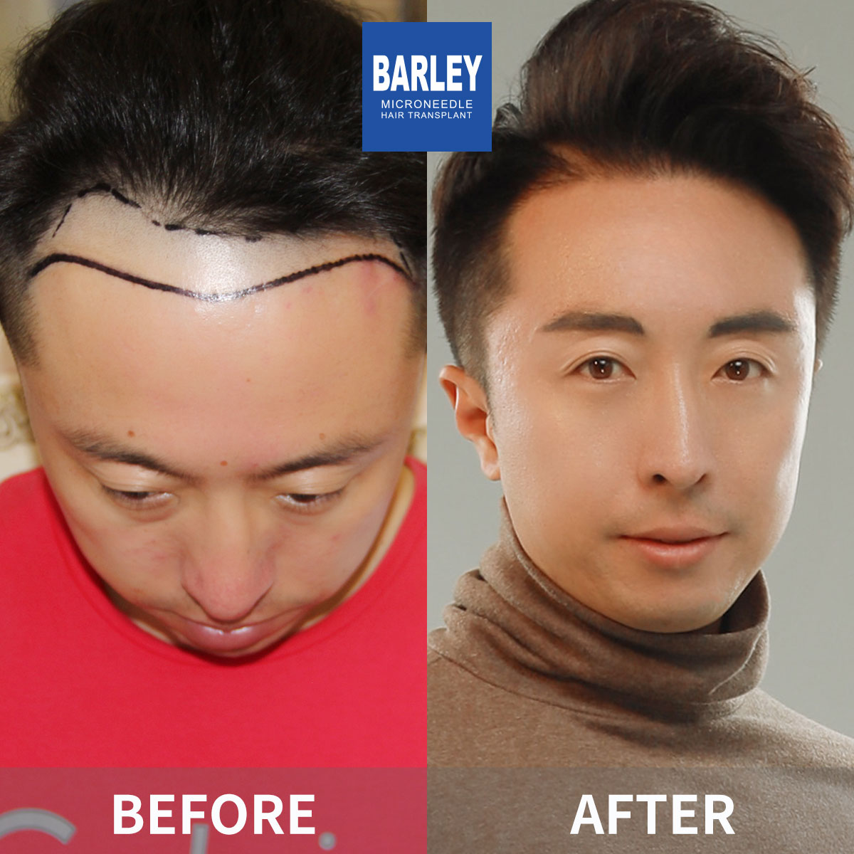 Hairline transplant before and after