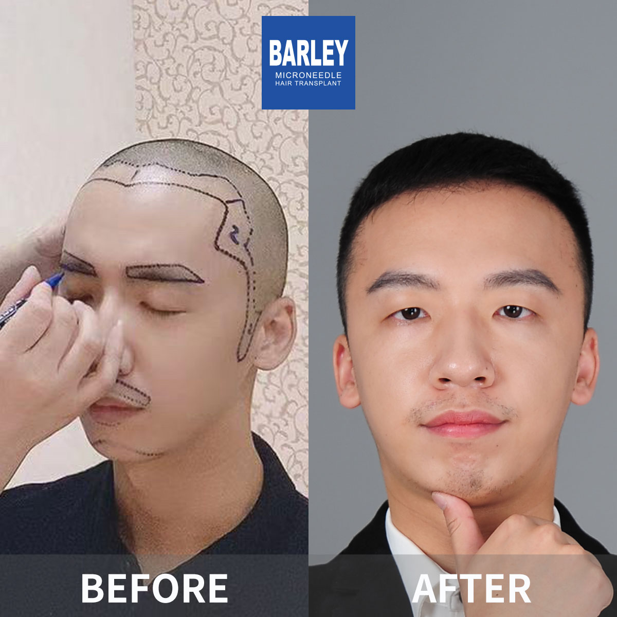 Hairline transplant before and after