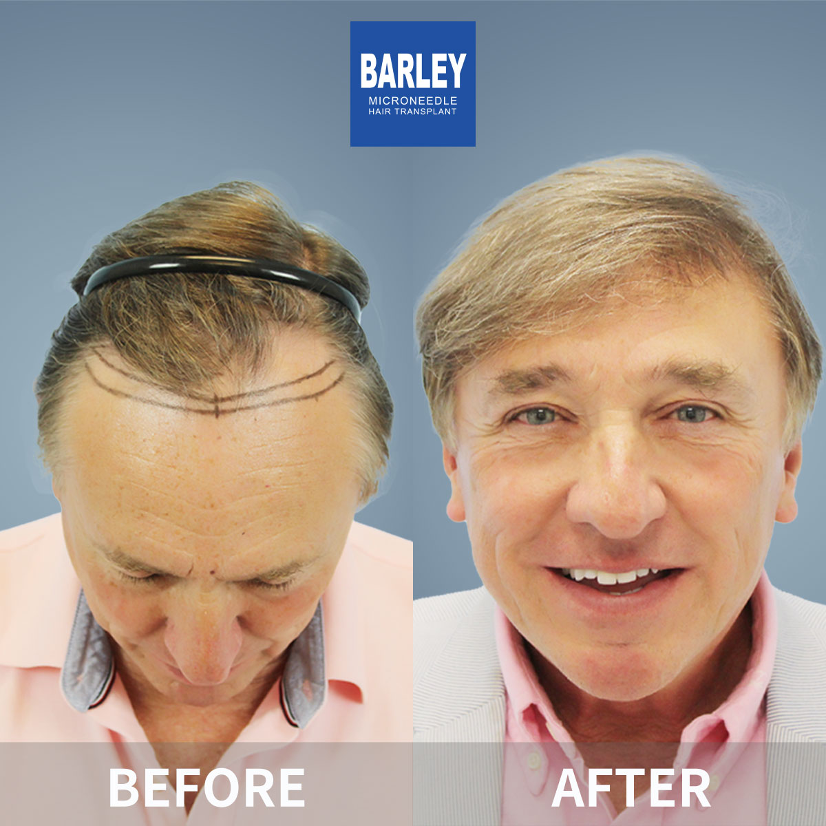 Hairline transplant before and after
