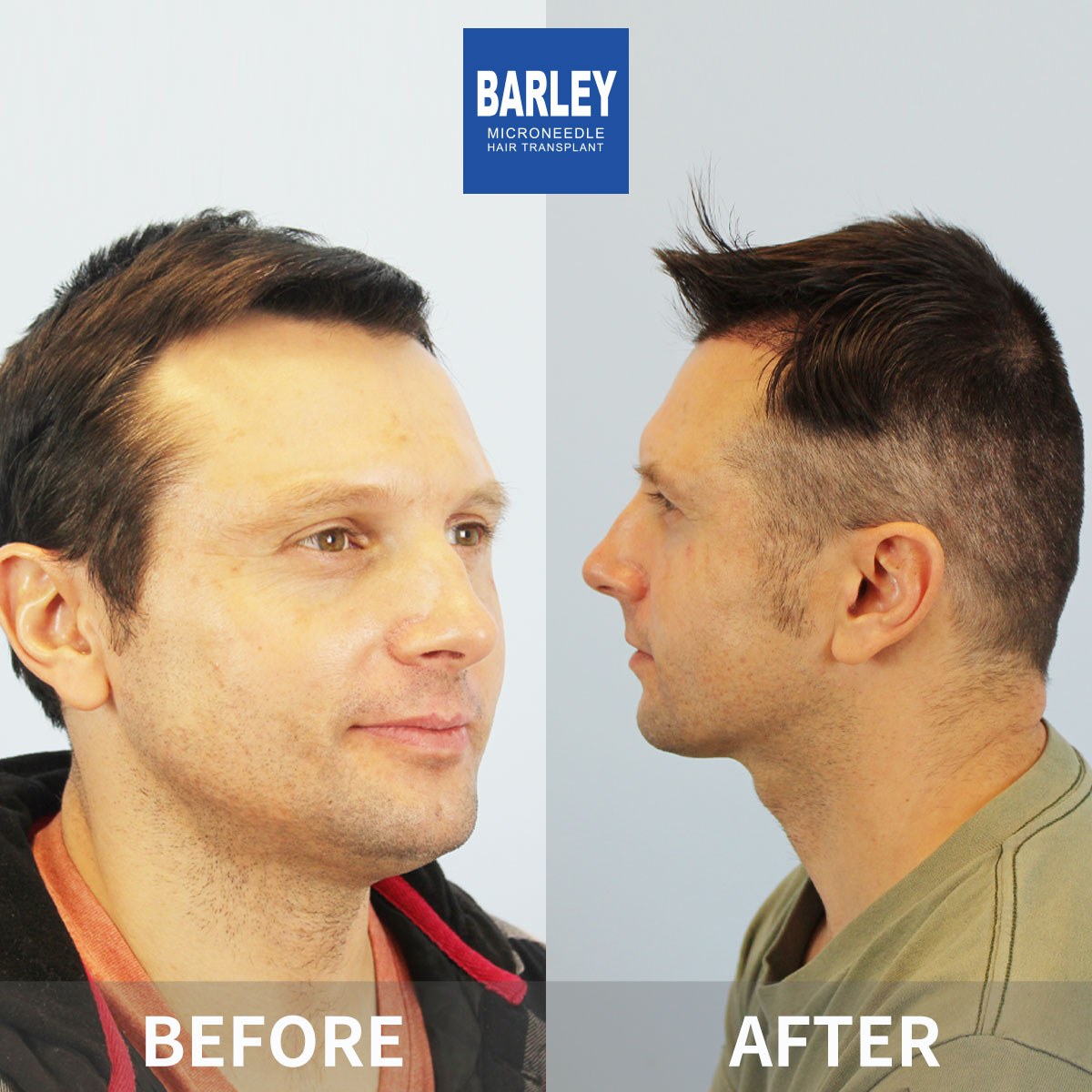 Hairline transplant before and after