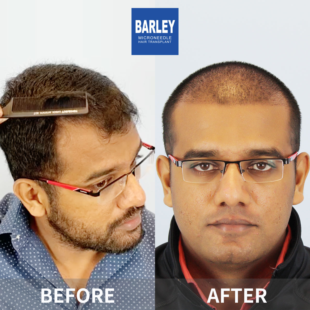 Hairline transplant before and after