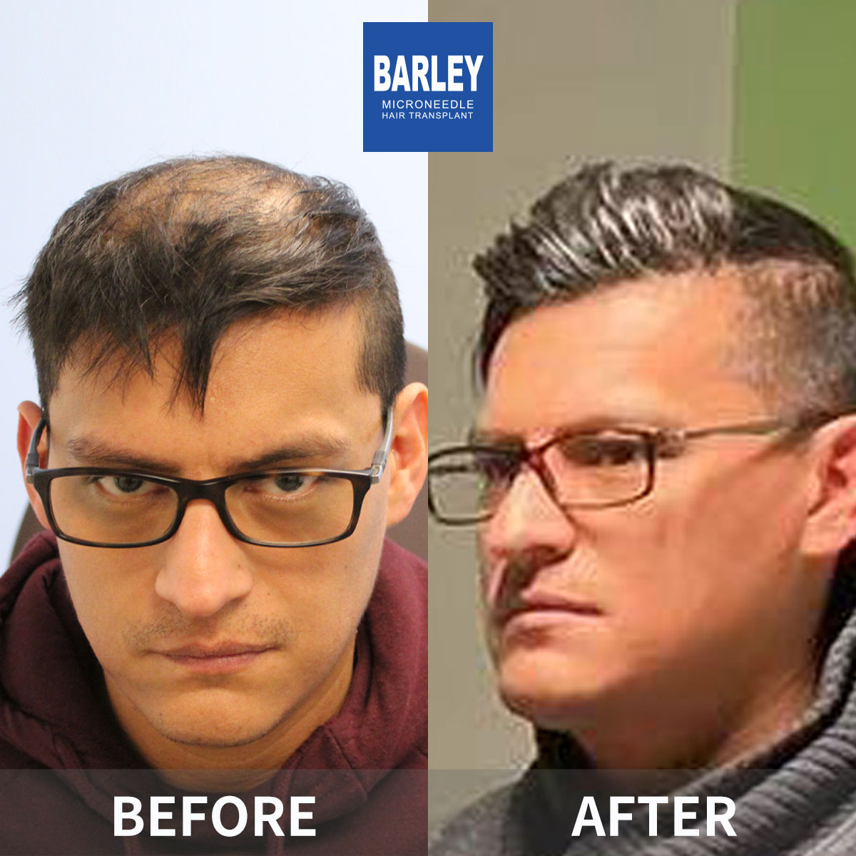 Hairline transplant before and after