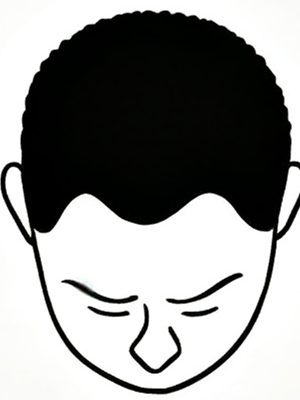 Stage 1 - No significant hair loss