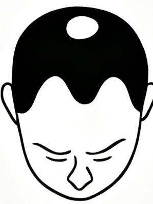 Stage 3 - Noticeable thinning