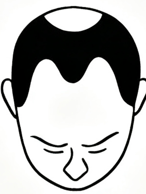 Stage 4 - Moderate balding
