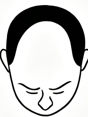 Stage 5 - Advanced hair loss