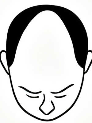 Stage 6 - Severe balding