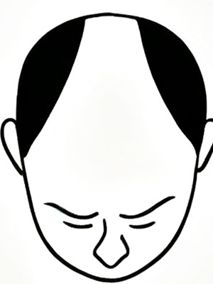 Stage 7 - Extensive balding